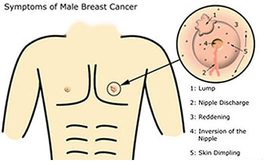 Propecia side effects (Male Brest cancer )