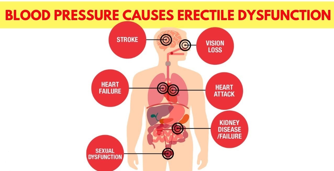 High Blood Pressure And Erectile Dysfunction Causes And Treatment