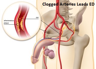 Clogged Arteries Lead ED