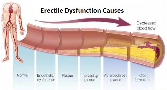 Erectile Dysfunction Causes