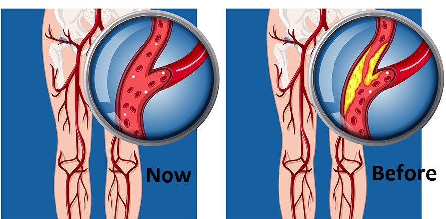 Erectile Dysfunction and Vascular Disease Treatment