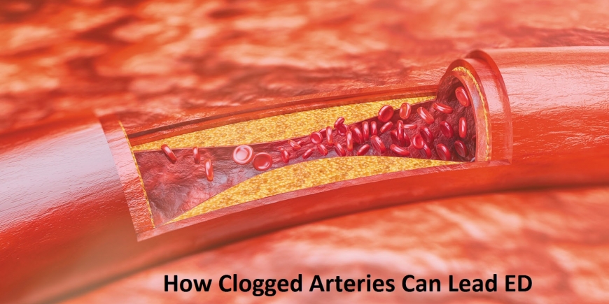How Clogged Arteries Can Lead ED