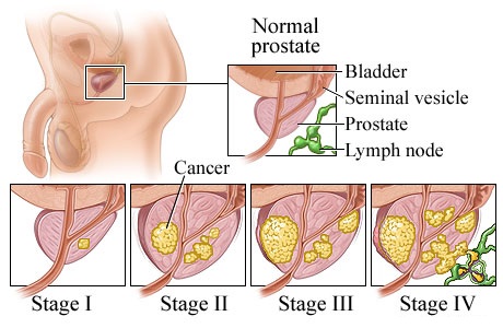 Prostate Cancer Symptoms Stages