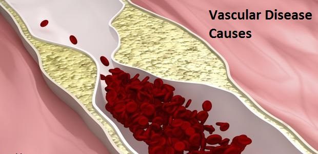 Vascular Disease Causes