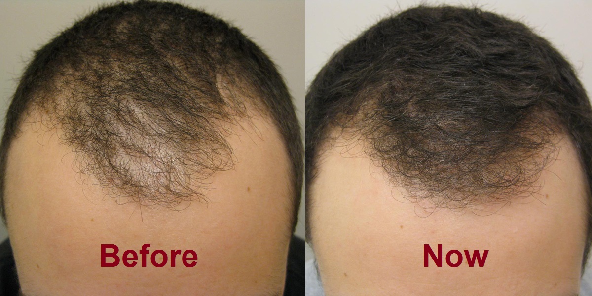 finasteride 5mg for hair fall