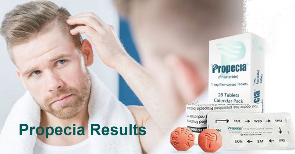 What Is The Best Timeline of The Propecia Results? Some Reviews