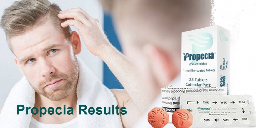 finasteride 5mg for hair fall