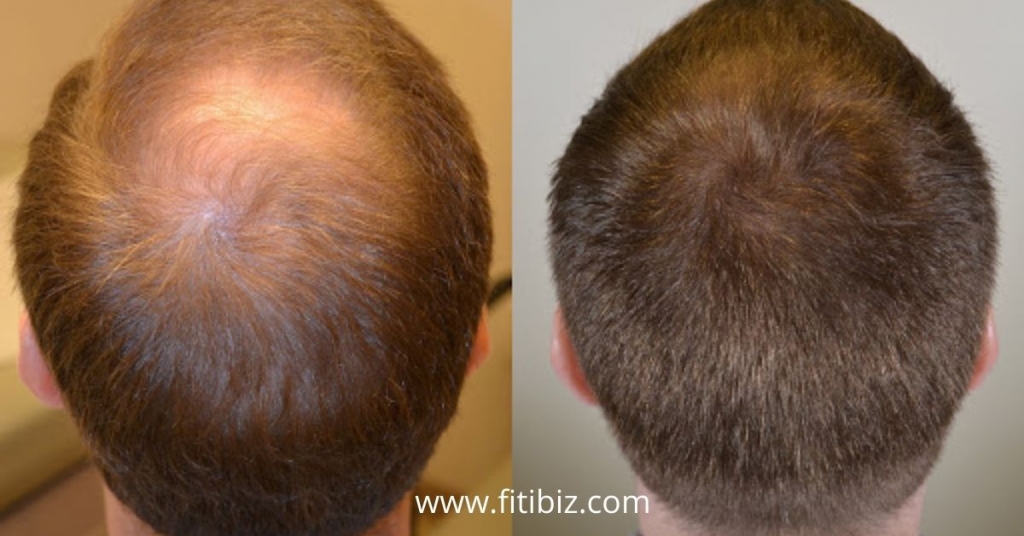 finasteride hair growth